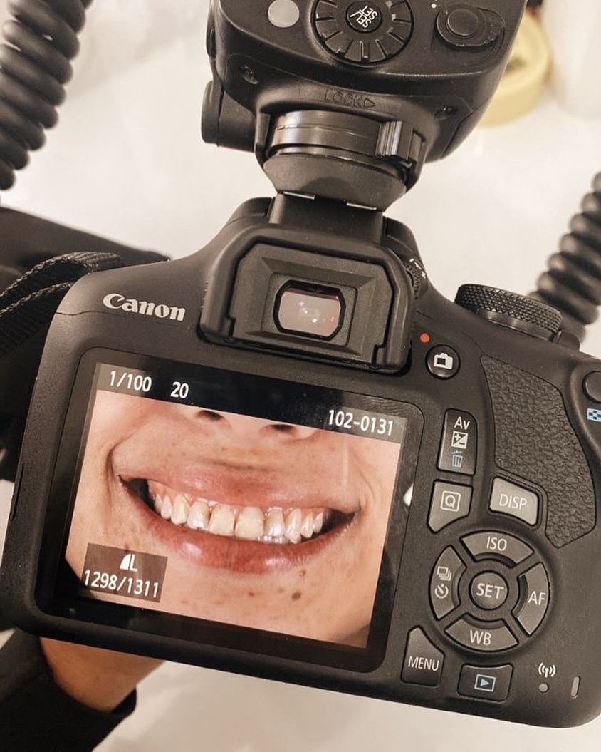 Этапы подготовки к отбеливанию зубов: важные шаги к яркой и здоровой улыбке